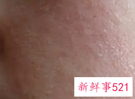 脸上干燥起皮发红紧绷怎么办