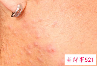 脸上脱皮干燥紧绷刺痛发红可以敷面膜吗