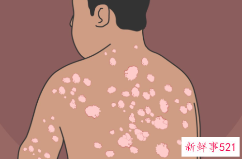 牛皮癣吃什么水果