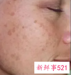 皮秒祛斑怎么样