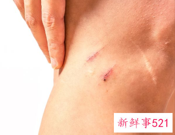 什么虫咬的半夜会痒