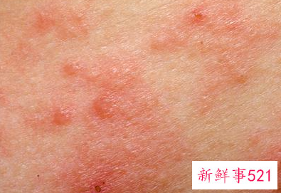 秋天对皮肤的注意什么问题