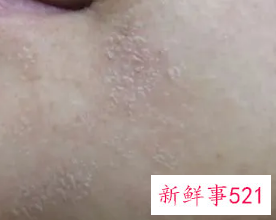 脸上干燥起皮发红紧绷怎么办