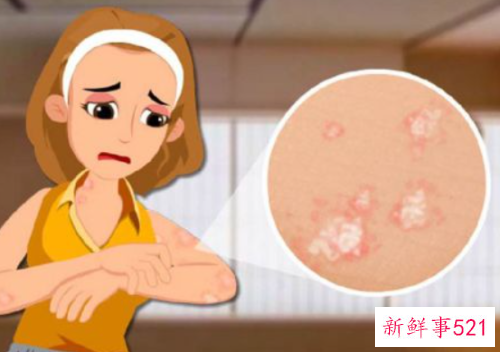 牛皮癣吃什么水果