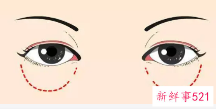 眼袋手术注意事项