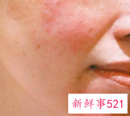 脸上干燥起皮发红紧绷怎么办