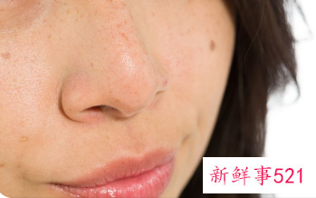 皮秒祛斑怎么样