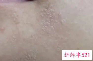 脸干燥脱皮补水刺痛是怎么回事