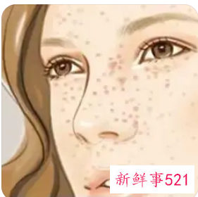 祛斑激光好还是药水