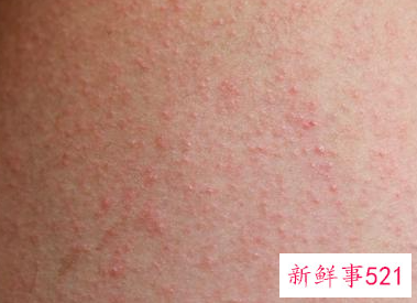 秋天对皮肤的注意什么问题