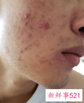 脸上有痘痘怎么解决方法