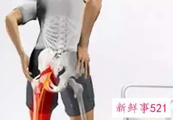 股骨头坏死的症状表现