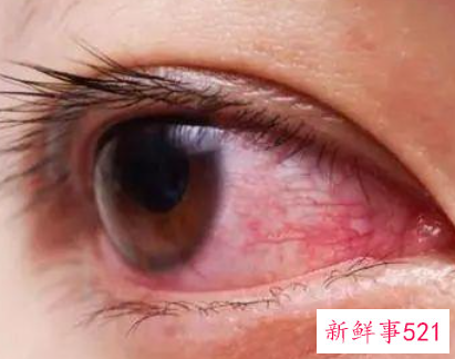 眼睛红血丝预示着哪种疾病