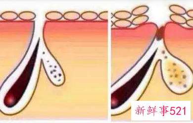 如何抑制油脂分泌