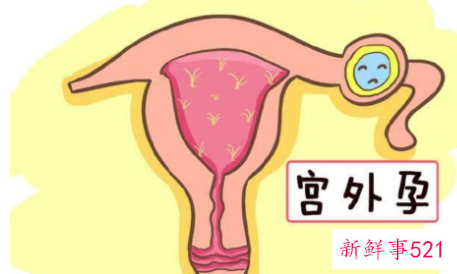引起宫外孕的原因
