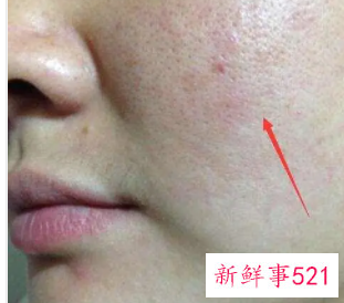 什么是螨虫型痘痘图片