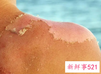 皮肤晒伤很严重怎么办