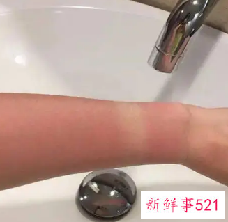 皮肤晒伤很严重怎么办