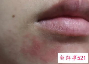 脸反复起皮痒红怎么回事