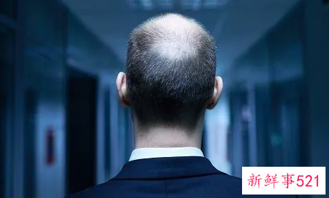 治疗脱发期间的饮食禁忌