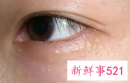 怎样消除眼角脂肪粒