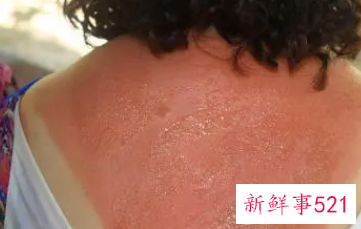 皮肤晒伤很严重怎么办