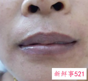 唇部周围发黑怎么回事
