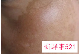 长斑原因有哪些