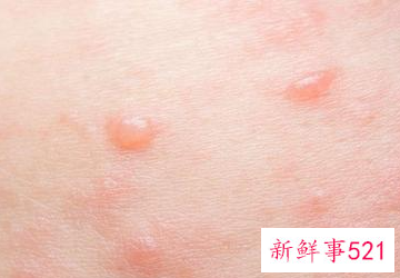 日光性皮炎会全身瘙痒吗