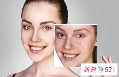 青少年长痤疮怎么样治疗