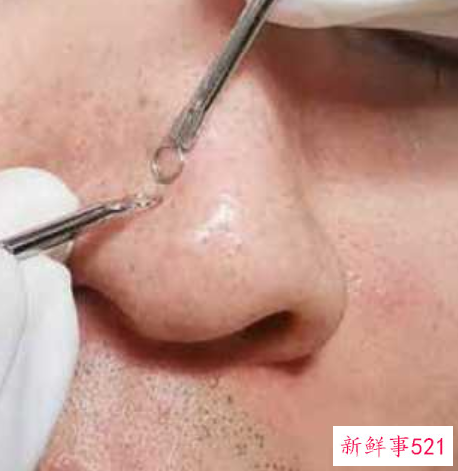 如何有效去除鼻子上的黑头