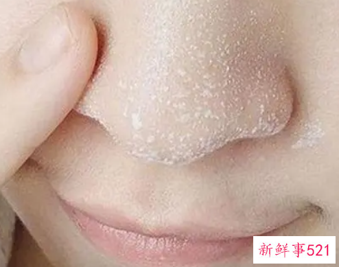 如何有效去除鼻子上的黑头