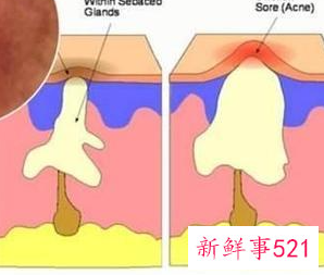 什么是螨虫型痘痘图片