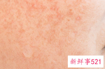 长斑原因有哪些