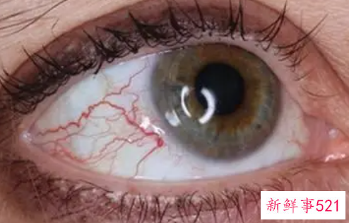 眼睛红血丝预示着哪种疾病