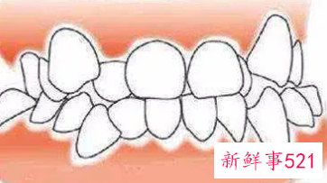 牙全部拔了对身体有伤害吗