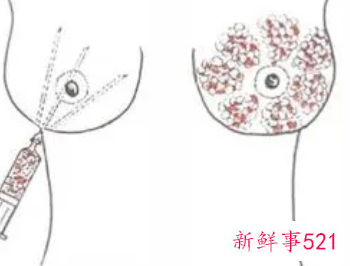 丰体针丰胸打什么层次