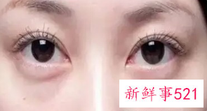 祛眼袋手术有后遗症吗危险吗