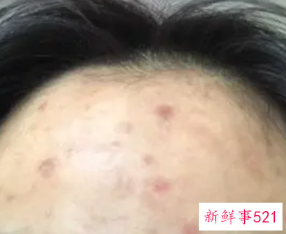 青少年长痤疮怎么样治疗