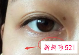 怎样消除眼角脂肪粒