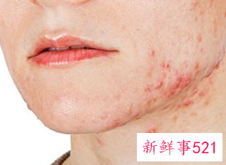 什么是螨虫型痘痘图片