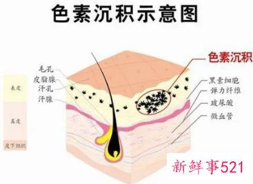 怎么把皮肤底层黑色素排出来