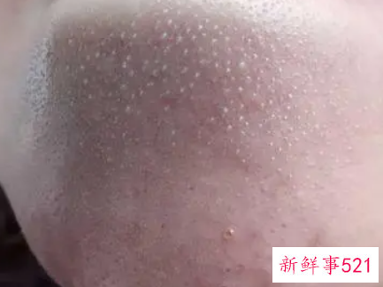 粉刺闭口是什么原因长出来的