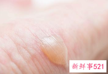 烫伤怎么处理好的更快