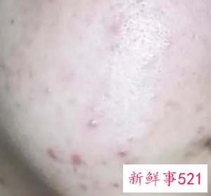 水油平衡是不是就不长痘痘