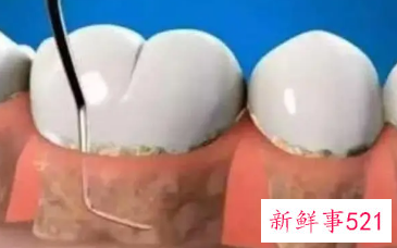 牙周炎怎样缓解疼痛