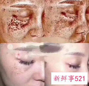 怎么把皮肤底层黑色素排出来