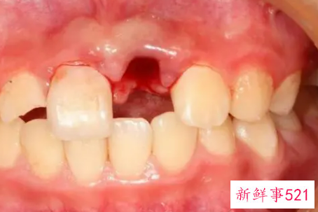 梦见下面的牙齿掉了