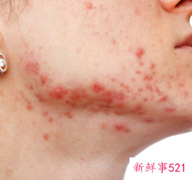 粉刺闭口是什么原因长出来的