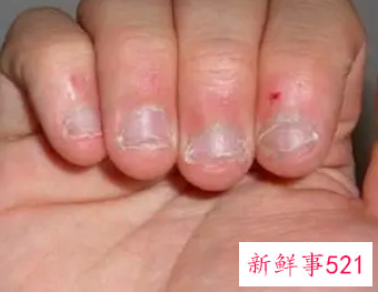 小孩咬指甲用什么药